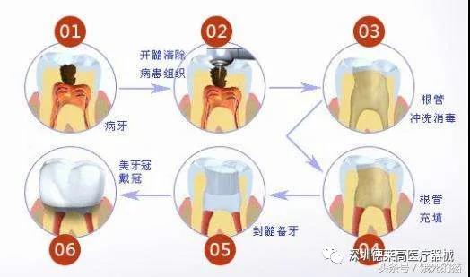 微创拔牙步骤